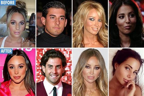 towie plastic surgery update